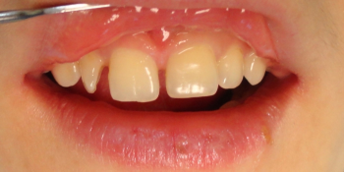 Исправление косметического дефекта передних зубов фото до лечения