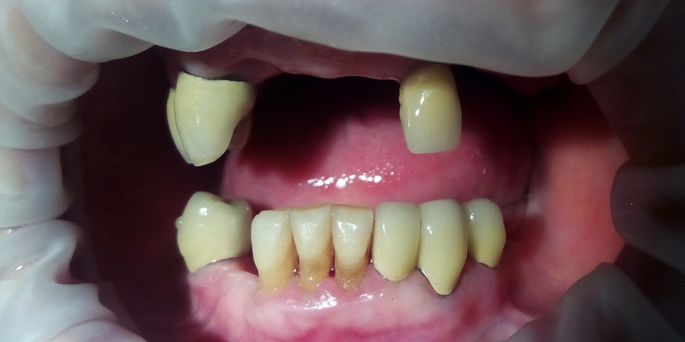 Пациент после протезирования. Вид в полости рта. Протезирования зубов верней и нижней челюсти