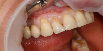 Зубы восстановили композитным реставрационным материалом Estelite фото до лечения