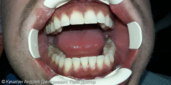 Результат удаления зубного налета фото после лечения
