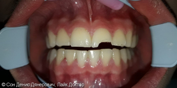Эстетическая реставрация фронтального зуба светоотверждаемым материалом Filtek (США) фото до лечения