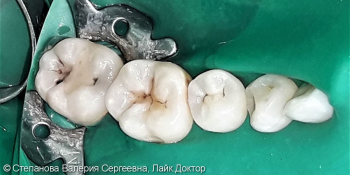 Глубокий кариес с переходом на контактную поверхность 4х зубов фото до лечения