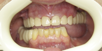 Установка виниров, реставрация зубов композитным материалом фото до лечения