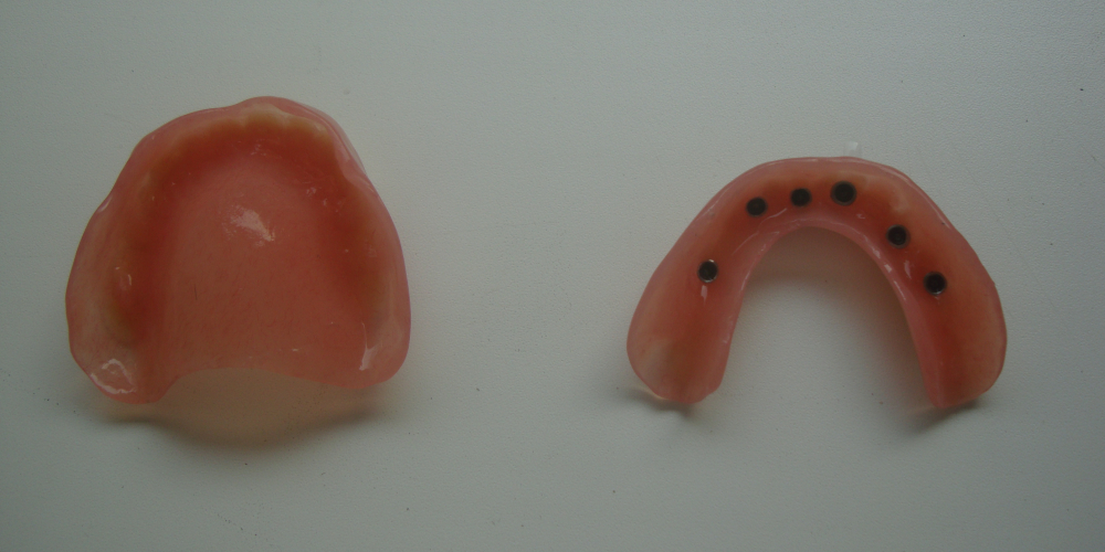 Готовые протезы. Зафиксированные в основании матрицы позволяют протезу жестко сидеть во рту. Восстановление зубов на верхней и нижней челюсти (полная адентия - отсутвуют все зубы)