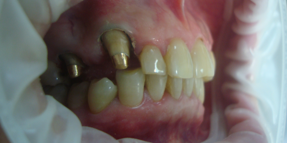 Пациенту зафиксированы индивидуальные культевые вкладки (драгоценный сплав), позволяющие укрепить родные зубы (2) Замена старого металлокерамического мостовидного протеза на новый