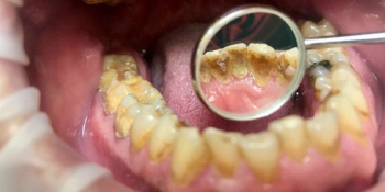 Результат профессиональной чистки зубов, до и после фото до лечения