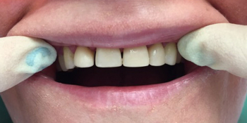Прямая реставрация фронтальной группы зубов с помощью компазитного материала Estelite фото после лечения