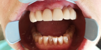 Протезирования зубов верней челюсти на имплантах фото после лечения