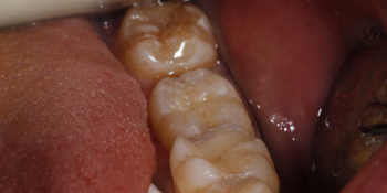 Рецидивный кариес зуба 36 фото после лечения