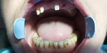 Имплантация зубов с протезированием несъемным керамическим протезом фото до лечения