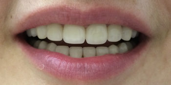 Протезирование передних зубов коронками из диоксида циркония фото после лечения