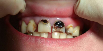 Прямая реставрация фронтальной группы зубов с помощью компазитного материала Estelite фото до лечения