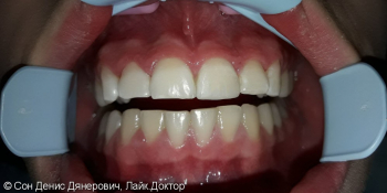 Эстетическая реставрация фронтального зуба светоотверждаемым материалом Filtek (США) фото после лечения