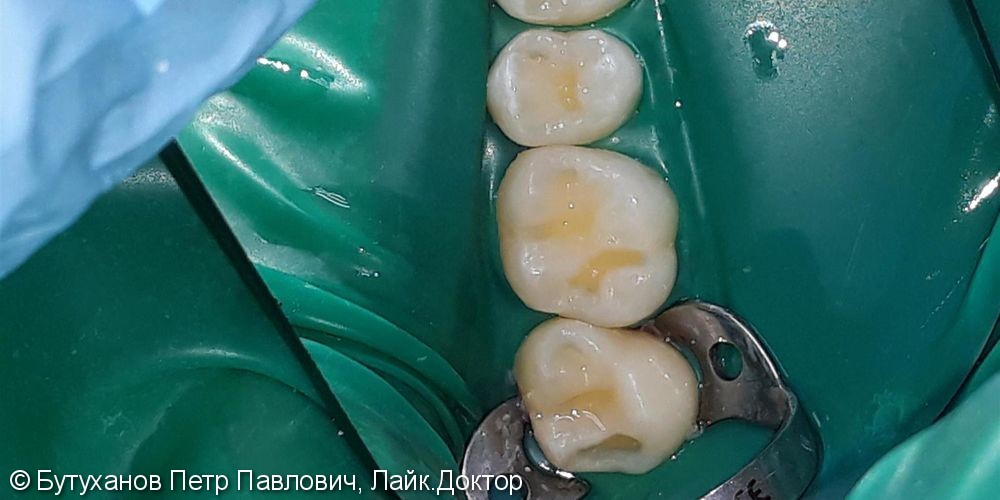  Проблема – кариес на четырех зубах