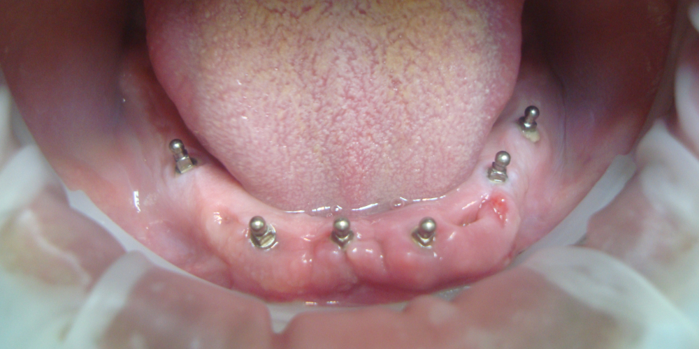 Исходная ситуация - беззубая нижняя челюсть.  Мини-импланты установлены в кость челюсти. Восстановление зубов на верхней и нижней челюсти (полная адентия - отсутвуют все зубы)